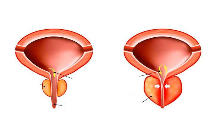 Prostate normal et enflammé