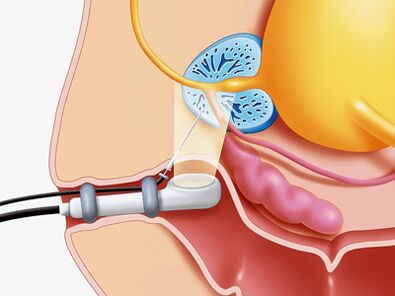 Biopsie Sting of the Prostate Gland