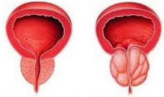 Prostate saine et enflammée
