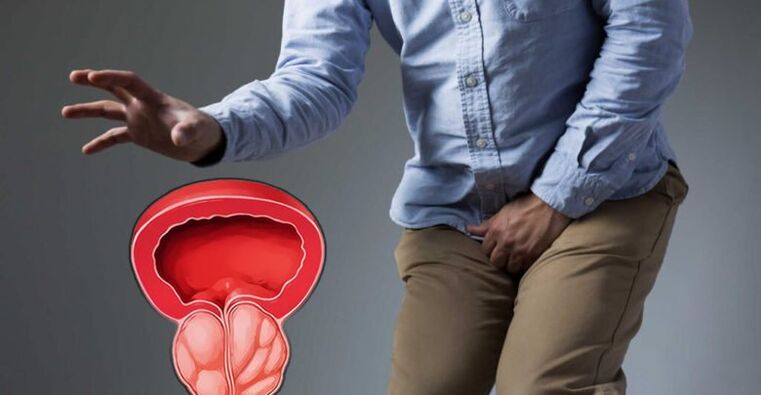 Prévention de la prostatite et adénome de la prostate