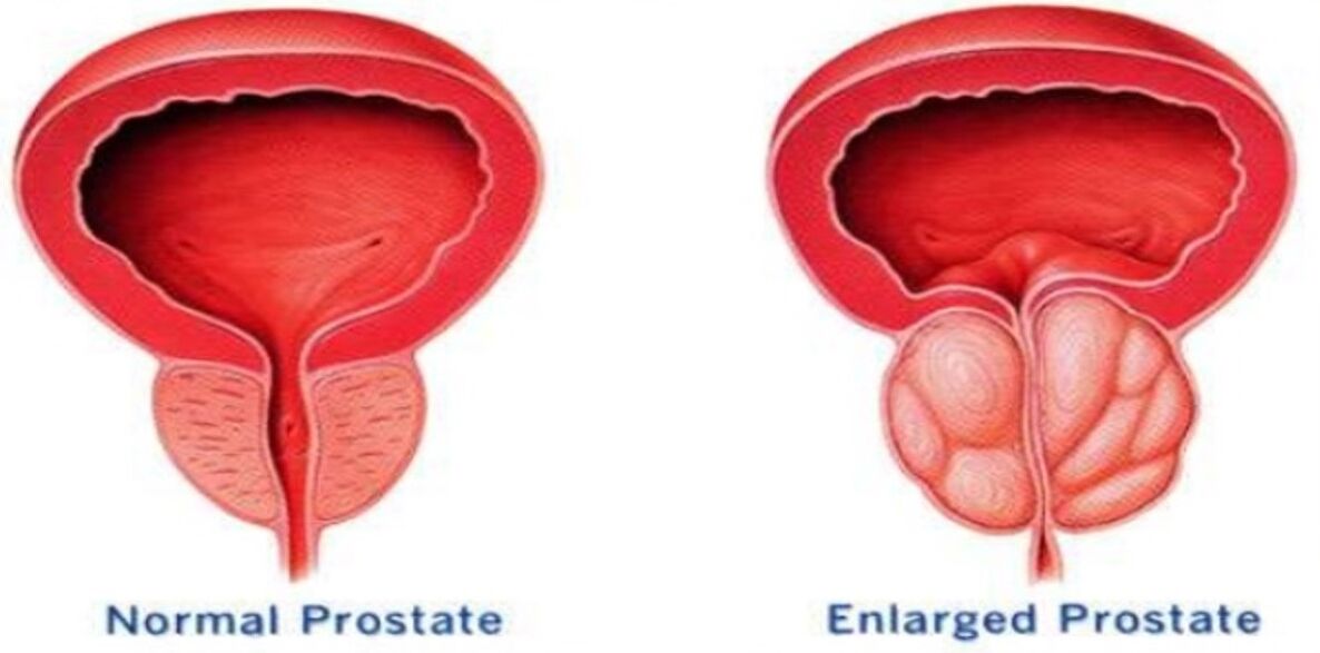 Prostate normal, prostate enflammée